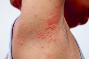 allergi utslag av dermatit problem. hud problem från läkemedel allergi. foto