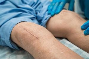 asiatisk senior eller äldre gammal damkvinnapatient visar hennes ärr kirurgisk total knäledsersättning sutur såroperation artroplastik på sängen i vårdavdelningen, hälsosamt starkt medicinskt koncept. foto
