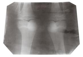 röntgen bild av två mänsklig knä-leder isolerat foto