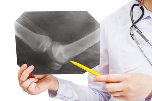 sjuksköterska visar röntgen bild med mänsklig knä gemensam foto