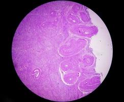 histologisk undersökning av livmoder biopsi suggestivt uterin framfall. kronisk cervicit med framfall. foto