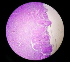 histologisk undersökning av livmoder biopsi suggestivt uterin framfall. kronisk cervicit med framfall. foto