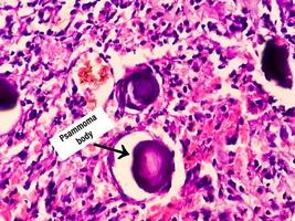 spinal tumör biopsi som visar psammomatös meningiom. psammoma kroppar. foto