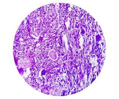 spinal tumör biopsi som visar psammomatös meningiom. psammoma kroppar. foto