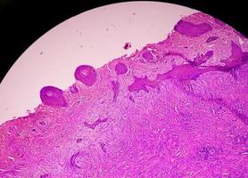 hud biopsi, suggestivt av basal cell carcinom, de mest allmänning typ av hud cancer. foto