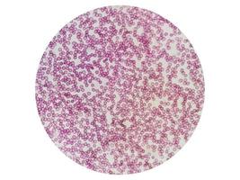 mikroskopisk se av hematologisk färgade glida. trombocytopeni. ytterst låg nivå av trombocyt räkna i blod. foto