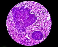 hud biopsi, suggestivt av basal cell carcinom, de mest allmänning typ av hud cancer. foto