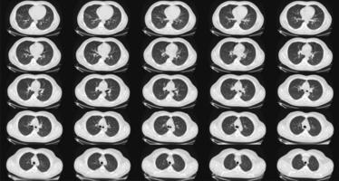 beräknad tomografi av de lungor i en friska vuxen man. vanligt lungor ct skanna. Maj vara del av covid-19 diagnostisk. foto