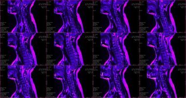 uppsättning av 6 sagittal grön färgad mri skannar av nacke område av caucasian 34 år gammal manlig med bilateral paramedial extrudering av de c6-c7 segmentet foto