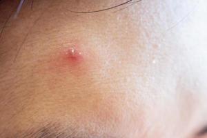 inflammatorisk acne med röd fläck på ansikte närbild foto