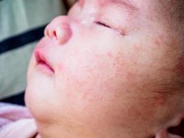 nyfödd bebis med allergi på ansikte foto