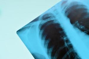 röntgen filma bild av mänsklig bröst för en medicinsk diagnos på blå sjukhus tabell. platt lägga topp se foto