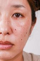 kvinnors hud hälsa problem med svart fläckar och utslag på de halv av de ansikte foto