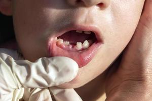 öppen mun av en pojke med felaktigt växande tänder, karies av bebis tänder, tog bort bebis tänder, tandvård och sjukvård foto