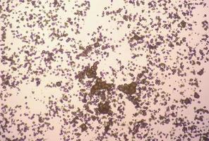 mikroskopisk bild av urinprov. onormal urin examen. urin syra kristaller. foto