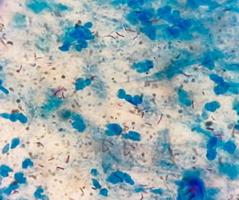 sputum eller slem smeta afb färga under mikroskopi som visar makrobakterie tuberkulos bakterie eller mtb foto