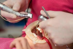 tandläkare rengör tand förfall i en barn med en borra, i de barnets mun ejektor saliv. foto
