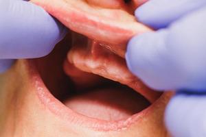närbild av en dental processer av implantation av tänder till en patient foto