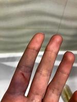 sårad, skära blå finger med en sår, en repa på en kvinnas hand, handflatan foto