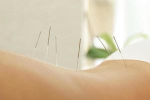 kvinna tillbaka med stål nålar under procedur av akupunktur terapi foto