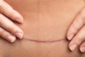 ärr efter c-sektion kirurgi på kvinna mage foto