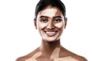 skön söder asiatisk kvinna med vitiligo hud oordning mot vit bakgrund foto