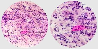 papper smeta. mikroskopisk undersökning av pap smeta som visar inflammatorisk smeta med tidigt atrofisk ändringar. cervical cancer diagnos. foto