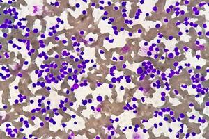 blod smeta under mikroskopi som visar kronisk lymfoblastisk leukemi eller cll foto
