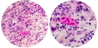 papper smeta. mikroskopisk undersökning av pap smeta som visar inflammatorisk smeta med tidigt atrofisk ändringar. cervical cancer diagnos. foto