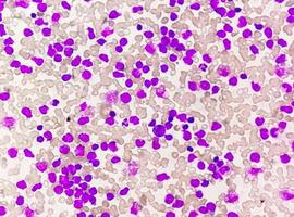 blod smeta under mikroskopi som visar kronisk lymfoblastisk leukemi eller cll foto