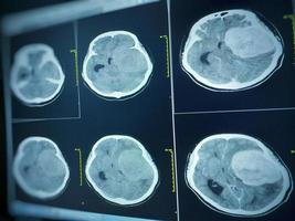 mri hjärna upptäckt av meningiom foto