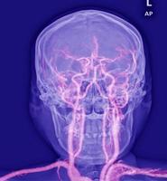 magnetisk resonans angiogram av de hjärna vaskulatur artärer foto