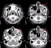 ct hjärna och paranasal bihålor intryck kronisk bihåleinflammation av lt maxillary sinus. foto