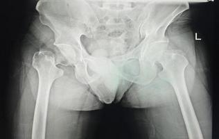 en bäcken- röntgen som visar stängd fraktur av intertrochanter av lårben med förflyttning foto