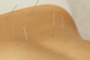 kvinna tillbaka med stål nålar under procedur av akupunktur terapi foto