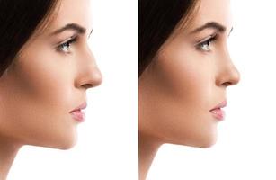jämförelse kvinna ansikte efter näsplastik på vit bakgrund foto