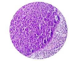 mikrofotografi som visar tunga skivig cell carcinom kvalitet ii. oral inkräktande scc. foto
