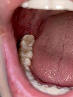 mjuk fokus. suturer efter visdom tand extraktion, dental kirurgi. oral hygien foto