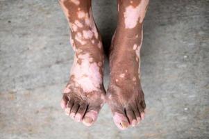 de gammal man ben med hud tillstånd den där orsaker förlust av melanin Framställ inomhus. de fot modell i svart tank topp lidande från vitiligo oordning. foto