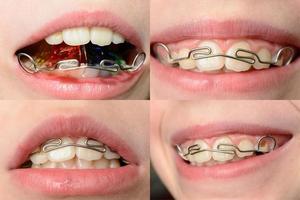 närbild mun av krokig tänder med tandställning tandborste i de mun av de tonåring foto