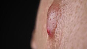 stor acne cysta böld eller ulcus svullen område inom ansikte hud vävnad. foto