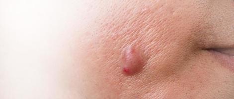 bakteriell hud infektion. stor acne cysta böld eller ulcus svullen område inom ansikte hud vävnad. som innehåller ackumulation av pus och blod. makro skott av acne eller dermatit nära mun på ansikte. hudvård. foto