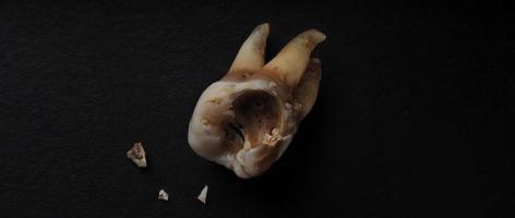 makro skott av en förfallen tänder till rot efter extraktion av tandläkare. foto