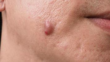 bakteriell hud infektion. stor acne cysta böld eller ulcus svullen område inom ansikte hud vävnad. som innehåller ackumulation av pus och blod. makro skott av acne eller dermatit nära mun på ansikte. hudvård. foto