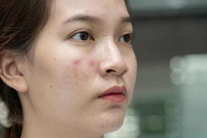 asiatisk ung med finne, acne, ärr på hud, ansiktsbehandling problem. foto