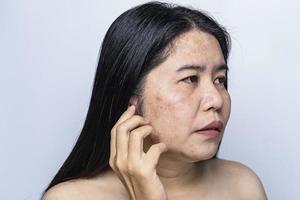 asiatisk vuxen kvinna ansikte har fräknar, stor porer, pormask finne och ärr problem från inte ta vård för en lång tid. hud problem ansikte isolerat vit bakgrund. behandling och hudvård begrepp foto