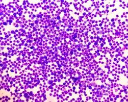 synovial vätska cytologi, massor wbc, mikroskopisk undersökning av synovial vätska, till diagnostisera artrit, särskilt för septisk eller kristallinducerad artrit. foto