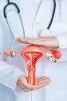 läkare innehav livmoder och äggstockar modell. äggstockar och cervical cancer, cervix oordning, endometrios, hysterektomi, uterin myom, reproduktiv systemet och graviditet begrepp foto