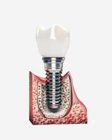 mänsklig tänder och dental implantera illustration. foto