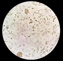 pyuria eller leukocyturi är de tillstånd av urin som innehåller vit blod celler eller pus. den kan vara en tecken av en bakteriell urin- tarmkanalen infektion foto